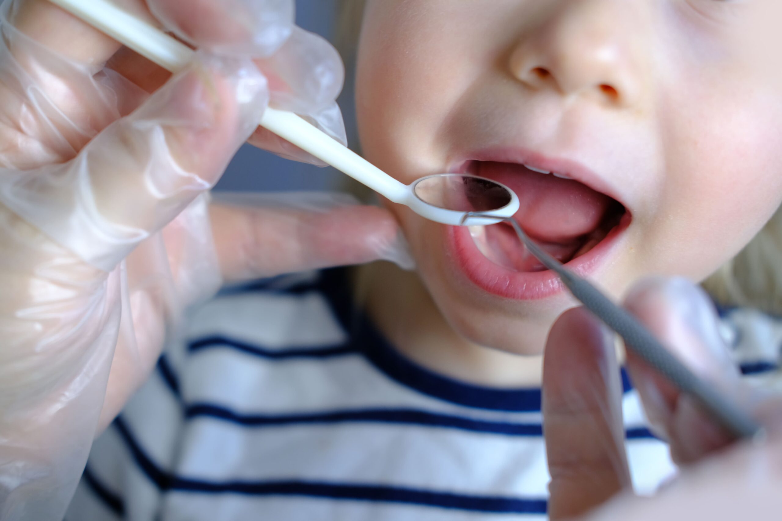 Is It Necessary for My Child to Use Space Maintainers