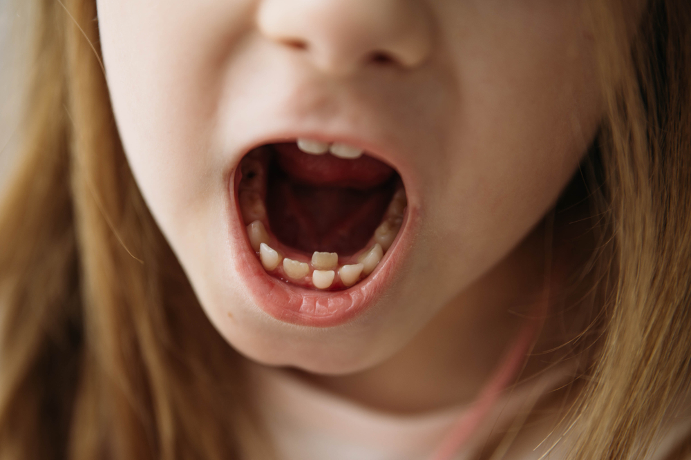 Dealing with Shark Teeth Permanent Teeth Behind Baby Teeth
