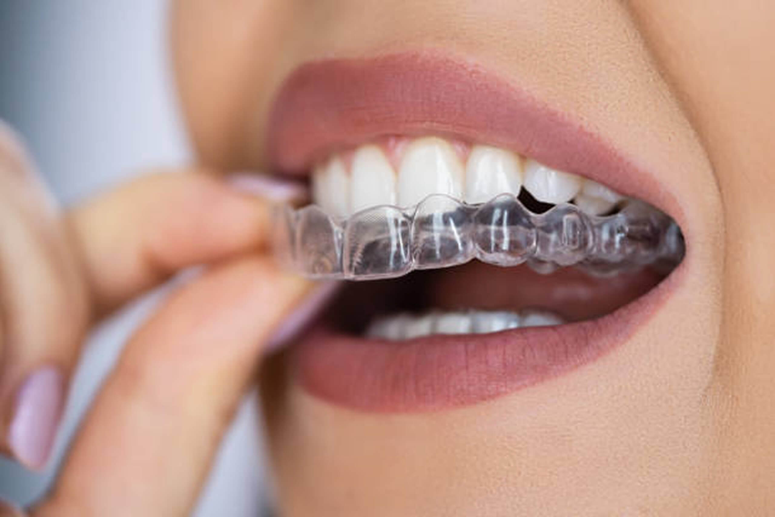 Invisalign Adults