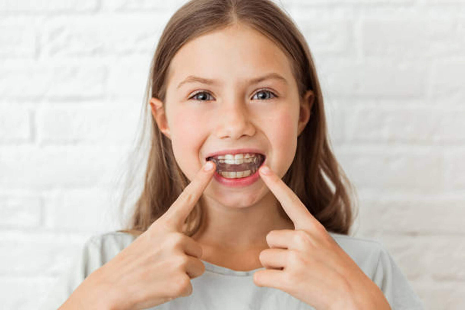 invisalign for kids in duluth