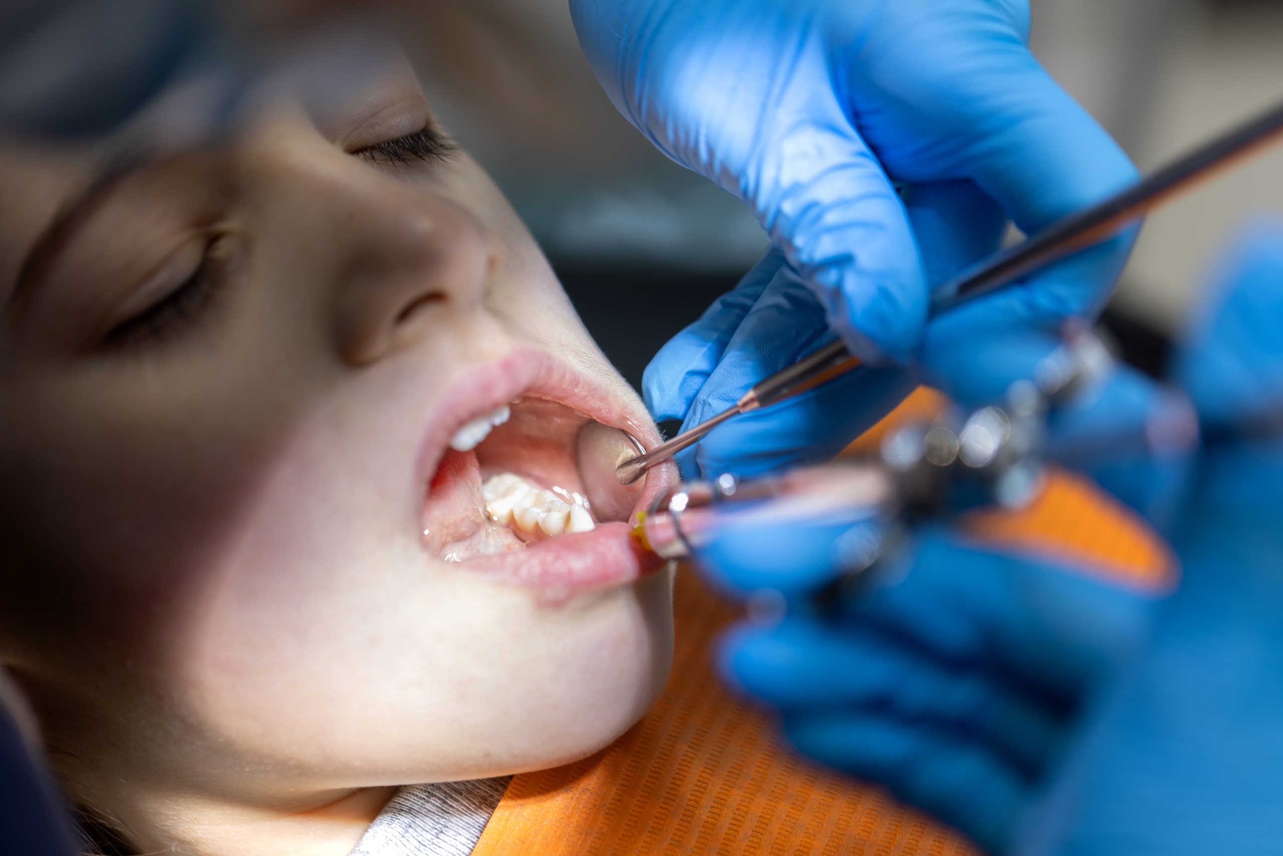 Dentist applying preventive dental sealant to a child's molar